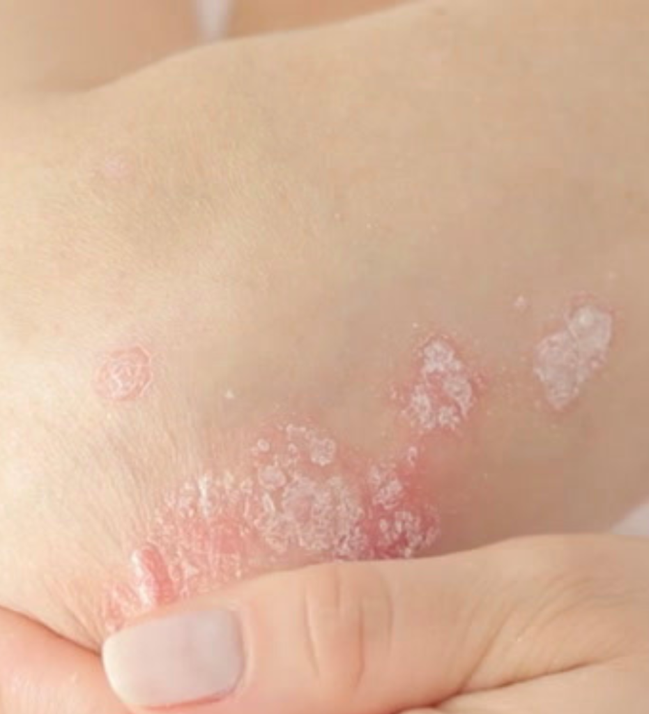 Symptoms of Dry Skin
Flakiness and Scaling